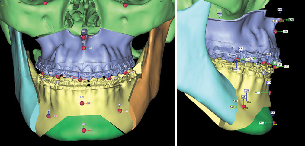 Virtual orthognathic surgery plan.