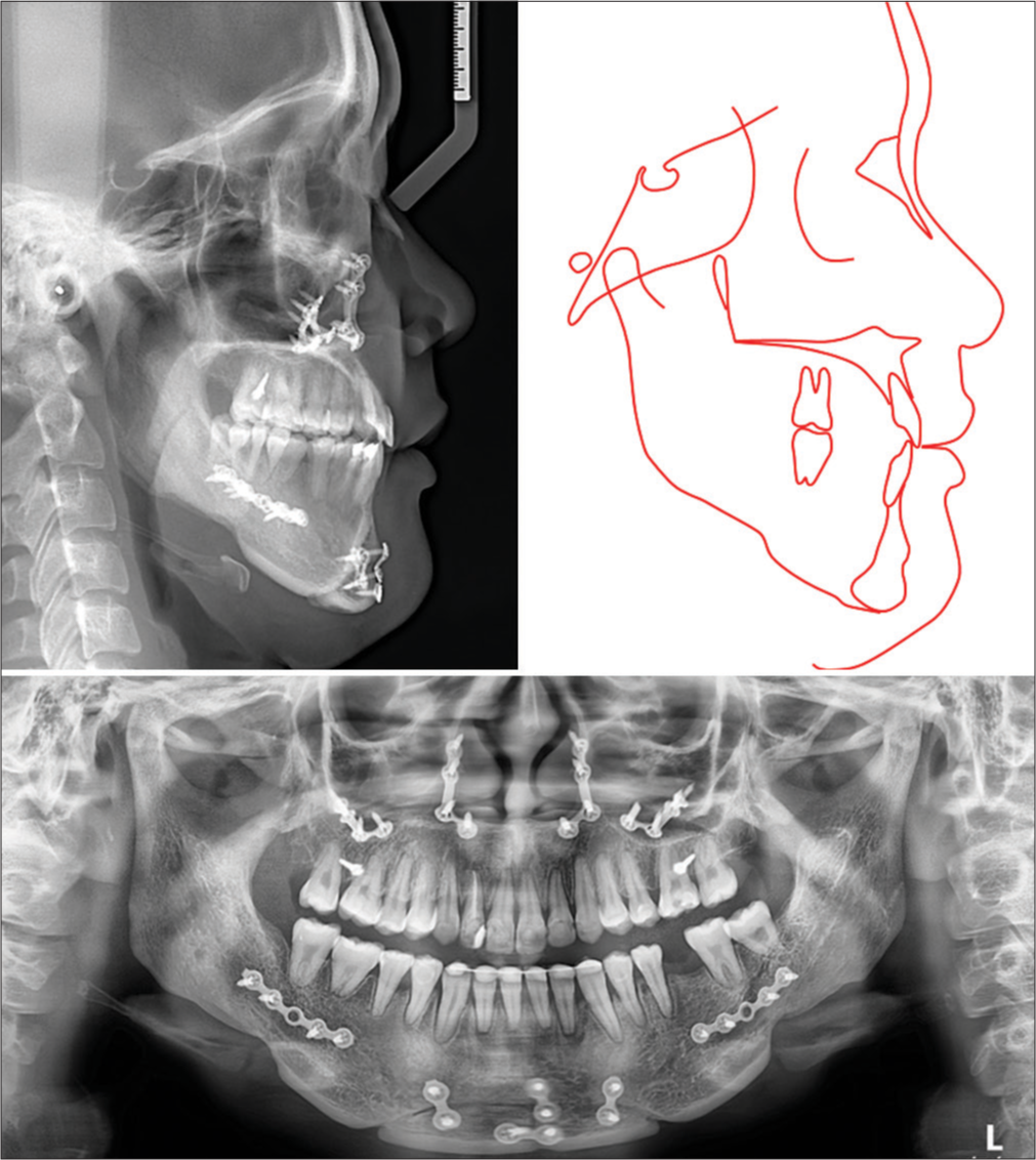Post-treatment radiographs and tracing.