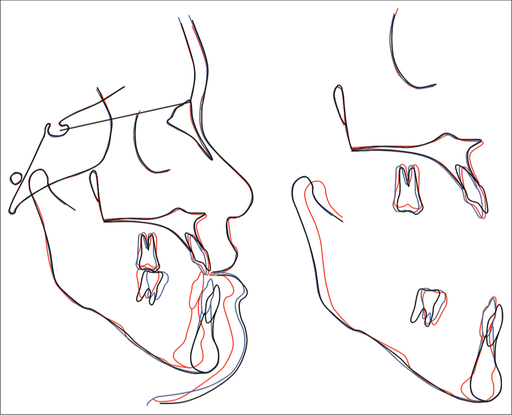 Overall and regional cephalometric superimpositions: Black: pre-treatment, blue: pre-surgery, red: post-treatment.