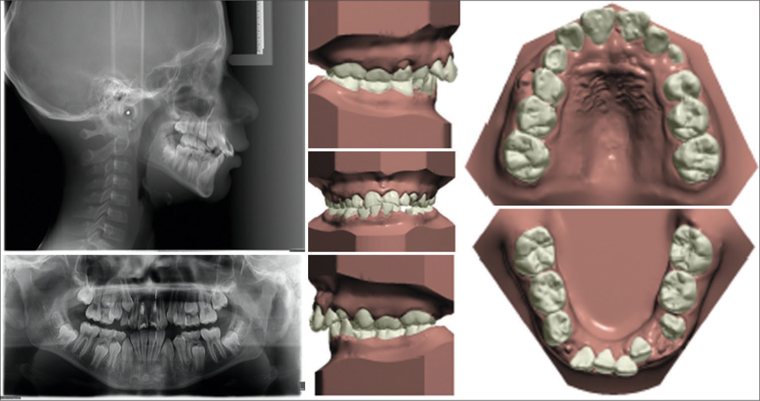 Pretreatment cephalogram, panoramic radiograph, and study models.