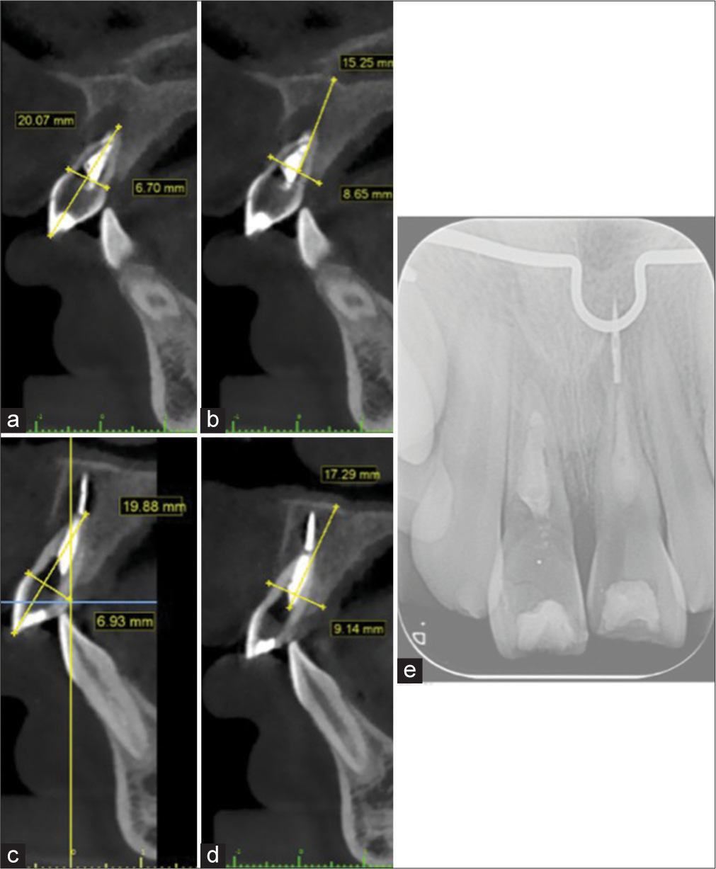 Sagittal clipping view (a and b) Left maxillary central incisor. (c and d) Right maxillary central incisor. (e) Periapical radiograph. The green lines indicates a reference ruler in milimeters.