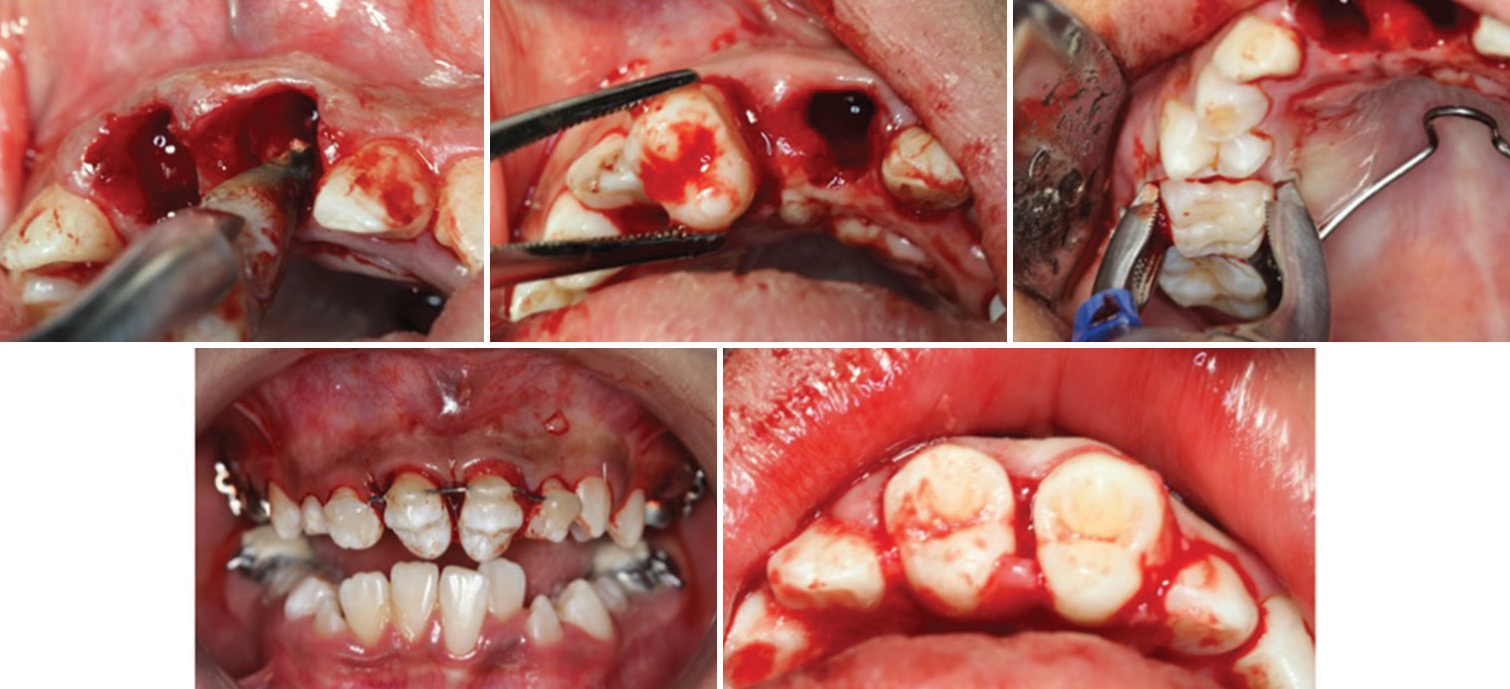 Autotransplantation surgery.